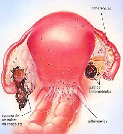 Bem Estar - HC retira cisto gigante de ovário por cirurgia minimamente  invasiva