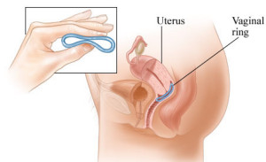 contraceptive_ring_in_place