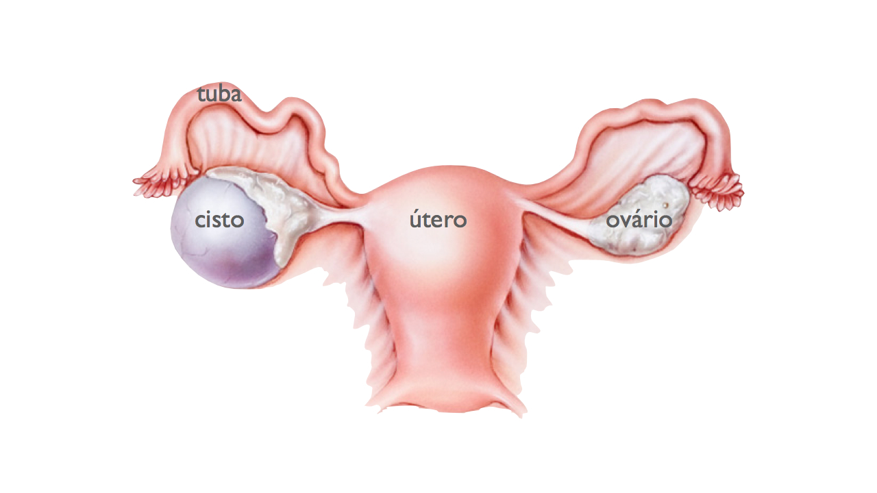 Apareceu um cisto no ovário? Veja o que fazer!